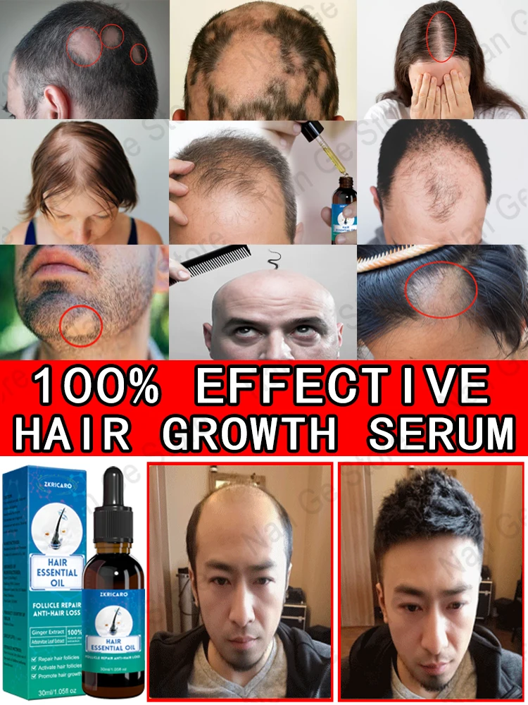 Unisex Hair Growth Oil Hair Loss Treatment Rapid Hair Growth Effective Baldness Repair Hereditary Postpartum Hair Loss